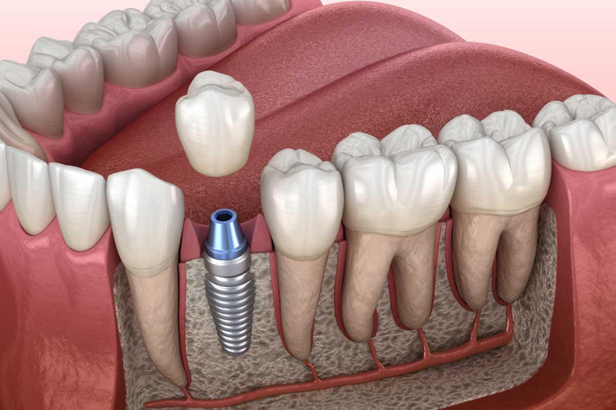 Single & Multiple Full Mouth Implants