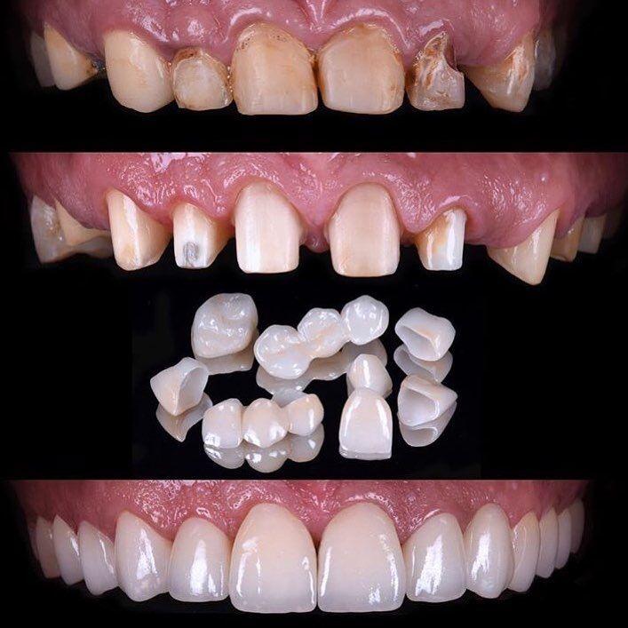 Smile Design