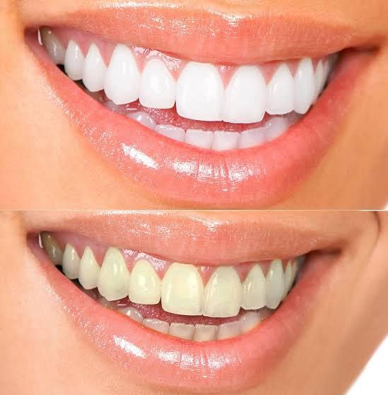 Teeth Whitening